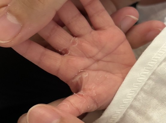 新生兒脫皮可以擦乳液嗎？新生兒脫皮原因、時間＆處理辦法一次看